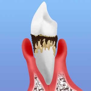 歯周病に気をつけなければいけないこわい理由